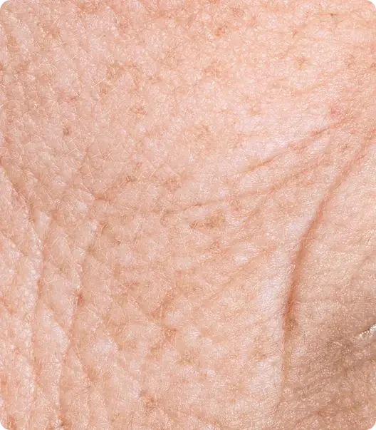 Fine lines & wrinkles